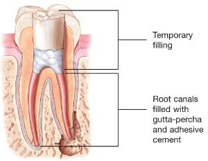 Root-Canal-Filling