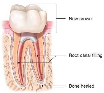 Dental Fillings  Procedure Details, Recovery Time & Cost Info