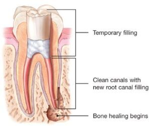 endodontic-retreatment-root-canal-temporary